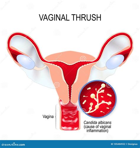 Vaginal Yeast Infection and Candida Albicans Stock Vector ...