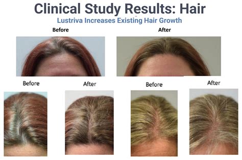 Accelerator Factor 的图像结果