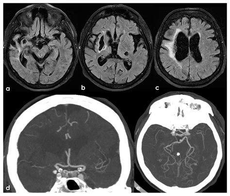 Neurovascular Issues in Antiphospholipid Syndrome: Arterial ...