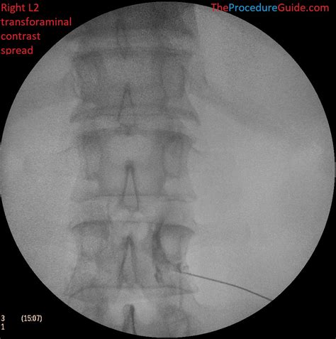 Fluoroscopy Injection 的图像结果