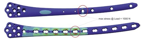 Biphasic Plate: ein neues Konzept der Osteosynthese - Orthopädie ...