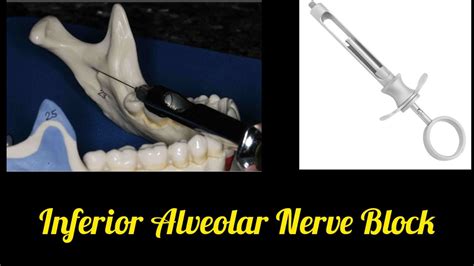 Image result for Single Tooth Root Nerve Block