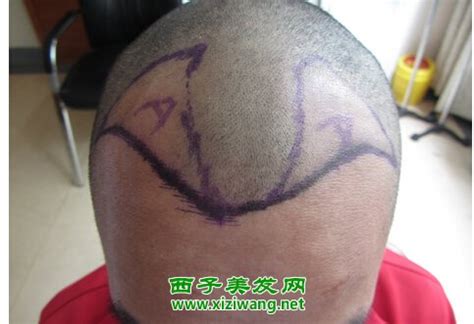 北京世熙整形医院植发科头发种植有哪些特点呢 有后遗症吗_千颜网