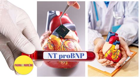 NT proBNP - Pagina de Nursing