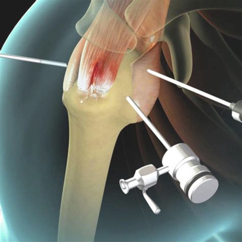 Shoulder Procedures - Premier Orthopedic Specialists of Tulsa