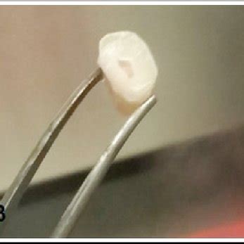 Image result for Pulp Extraction Tooth
