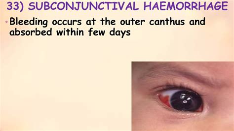 minor disorders of neonates and its management - shani -ppt- slideshare ...