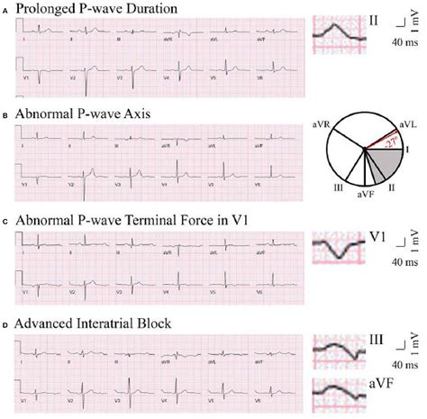 Frontiers | P Wave Indices—Advancing Our Understanding of Atrial Fibrillation-Related ...