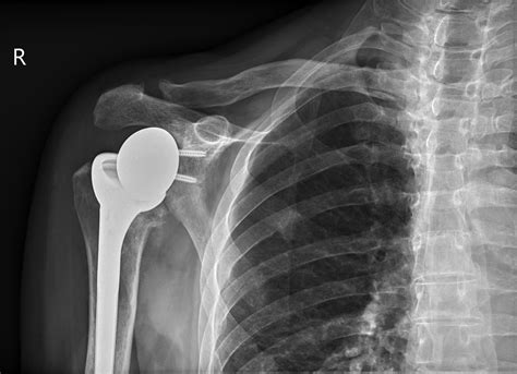 X Ray Of Reverse Total Shoulder Replacement at Jaclyn Glenn blog