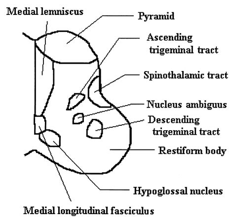 Medial Medullary Syndrome | Stroke