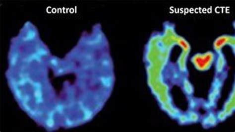 CTE Brain 的图像结果
