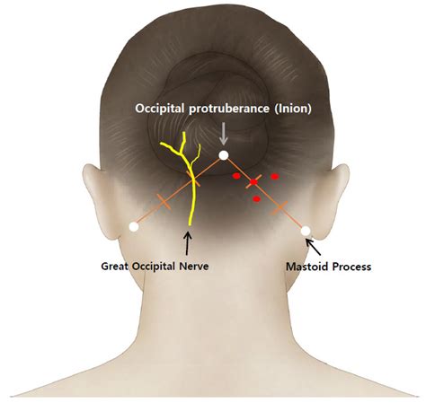 Greater Occipital Nerve Pain