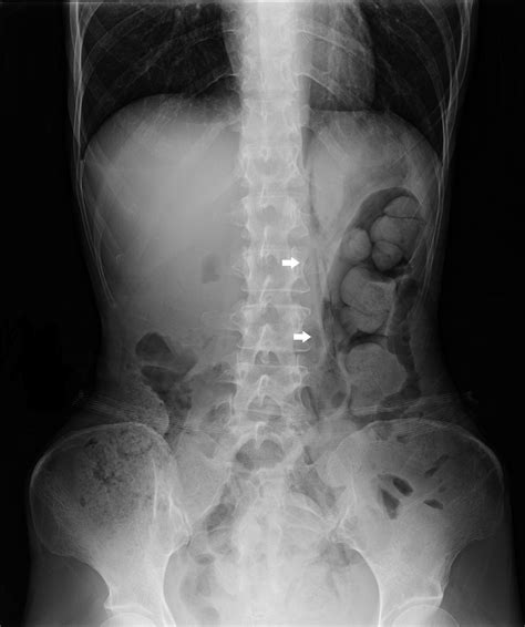 Image result for Psoas Sign