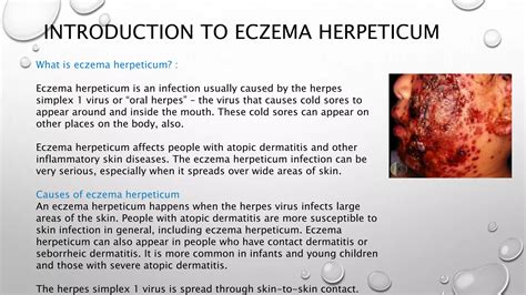 ECZEMA - dermatology case presentation | PPTX