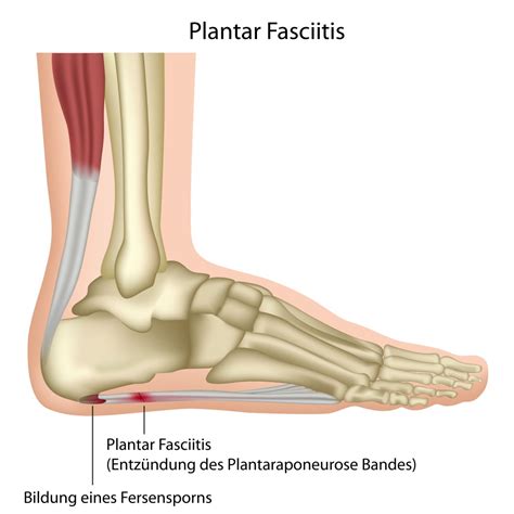 Plantar Faciitis Natural Remedies: Symptoms & Surgery for Plantar Faciitis | Natural Remedies.org