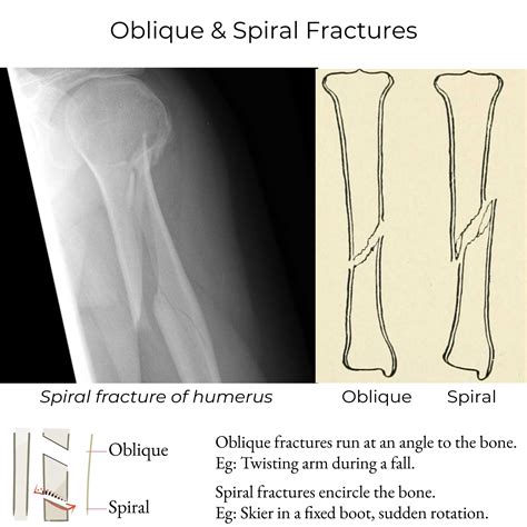 Spiral Fracture In Arm