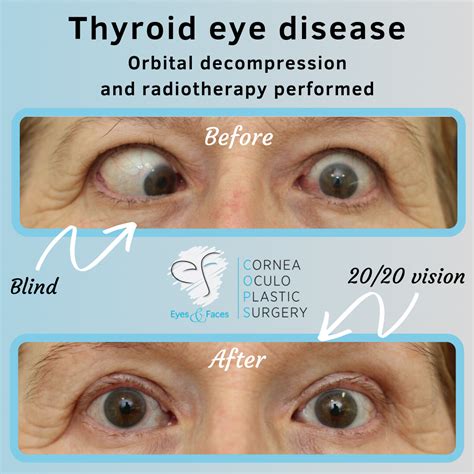 Thyroid Eye Disease - Thyroid Eye Disease