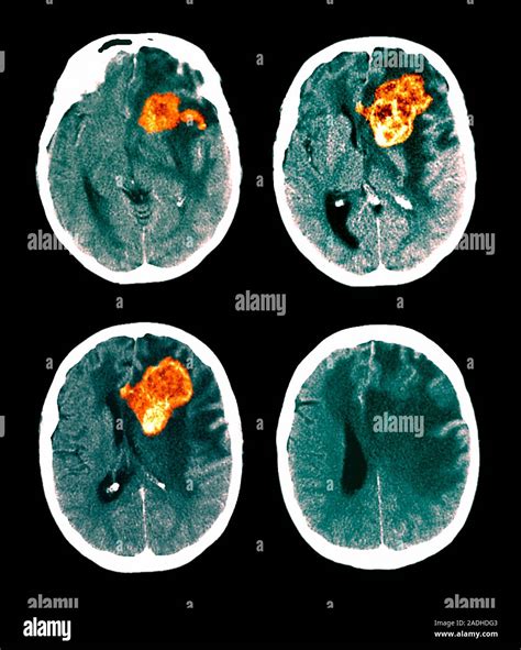 Brain Cancer Ct Scan