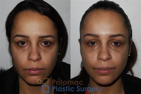 Supplements To Reduce Swelling After Plastic Surgery at Zane Stirling blog