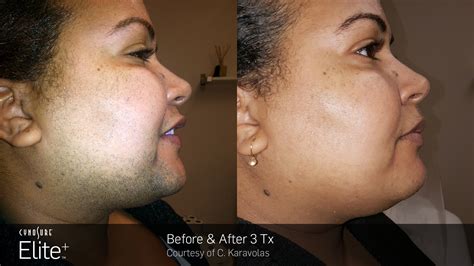 Laser Hair Removal in Westport & New Canaan, CT | Lasting Hair Reduction
