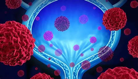 Trimodality therapy as good as radical cystectomy for select patients ...