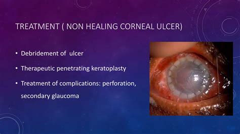 Bacterial corneal ulcers.pptx