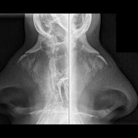 Pediatric Nasal Bone Fracture | Pediatric Radiology Reference Article | Pediatric Imaging ...