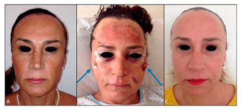 An Easy and Effective Technique for Silicone Facial Implant Insertion ...