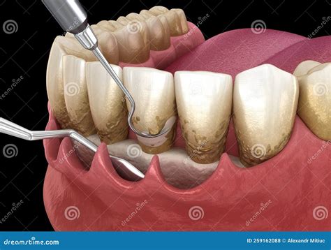 Open Curettage: Scaling and Root Planing Conventional Periodontal Therapy. Medically Accurate 3D ...