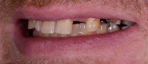 Dental Implants | Dentist Greer SC | Brushy Creek Dental Partners