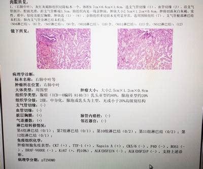 乳腺癌病理报告怎么看_乳腺癌_乳腺癌检查 - 好大夫在线