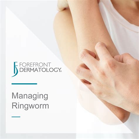 Managing Ringworm - Forefront Dermatology