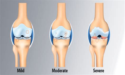 Know The Reasons Why Osteoarthritis Causes Knee Pain - eBuddy News