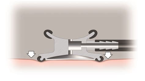 Littmann Master Classic II 2141 Stethoscope (Black) : Amazon.in ...