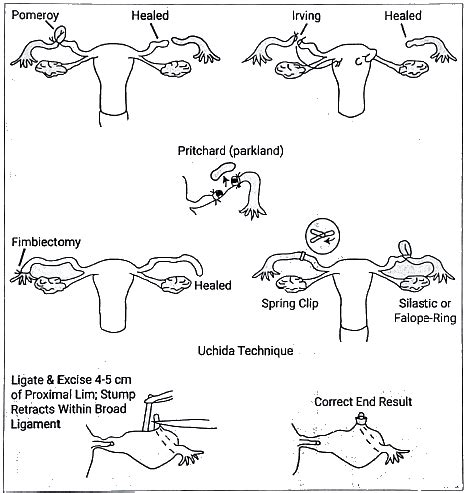 Urinary Bladder, Uterine Tubes, Vas Deferens: Clinical Anatomy ...