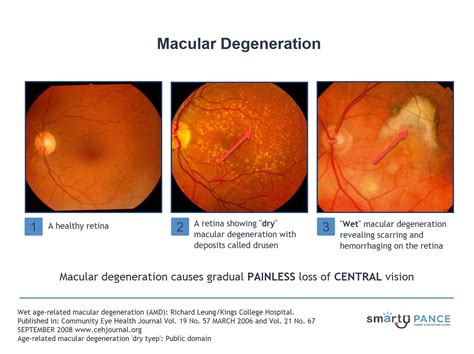 Dry Vs Wet Macular Degeneration