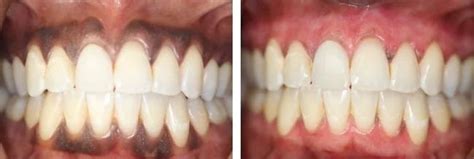 Cure Black Gums: Remedies to Lighten and Restore Gum Health – Perfora ...