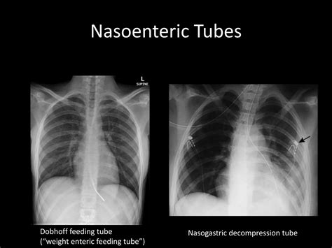 Lines, Tubes and ICU CXR - Smith | PPTX