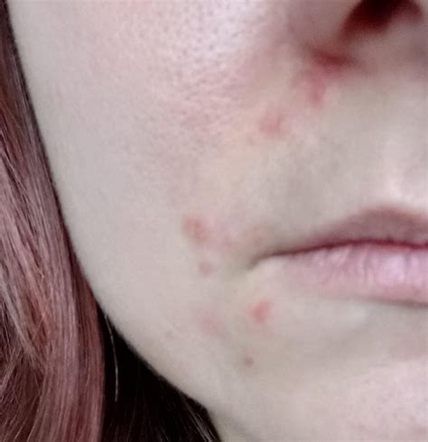 Red marks on face... : r/DiagnoseMe
