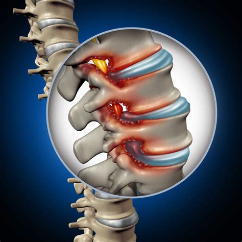 What is Foraminal Stenosis? - Spine Health & Wellness