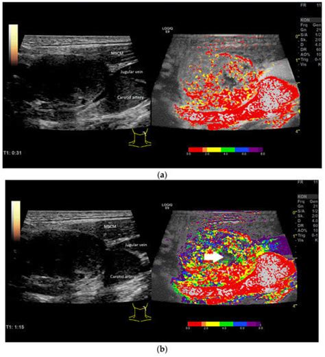 Multiparametric Ultrasound of Cervical Lymph Node Metastases in Head ...