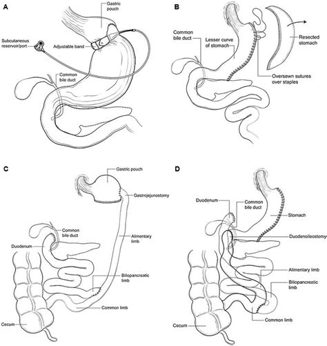 Image result for Colon Polyps Types