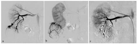 Safety, Efficacy and Mid-Term Outcome for Transarterial Embolization (TAE) of Renal ...