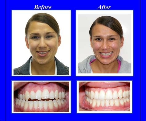 Image result for Crossbite Treatment Options
