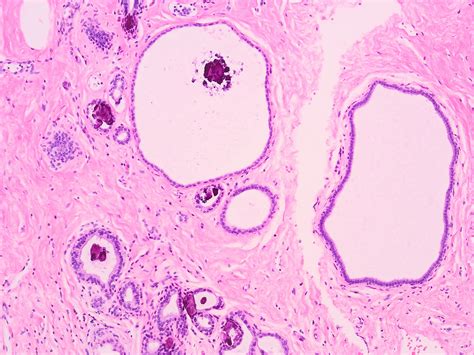Pathology Outlines - Nonproliferative fibrocystic changes