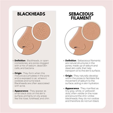 Skin by Christiane | ⚫️Blackheads vs Sebaceous Filaments⚫️ Sebaceous filaments are different ...