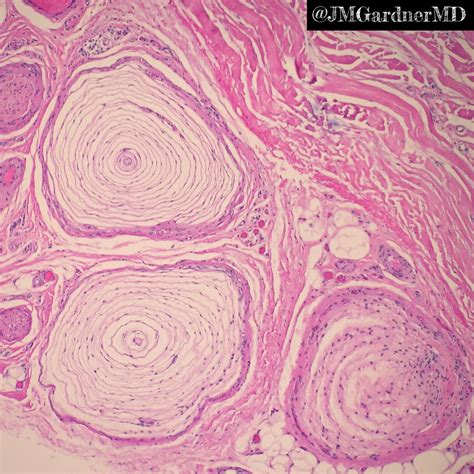 Pacinian Corpuscles Histology