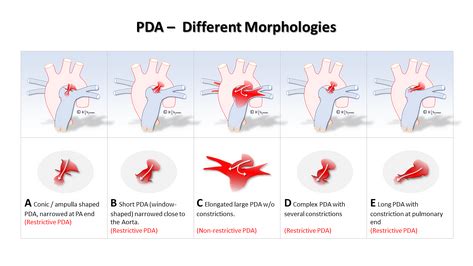 Early PDA 的图像结果