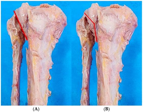 Articulacao Tibiofibular Proximal