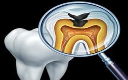 一例急性牙髓炎伴结节性钙化牙齿的救赎-牙医小磊的博客-KQ88口腔博客